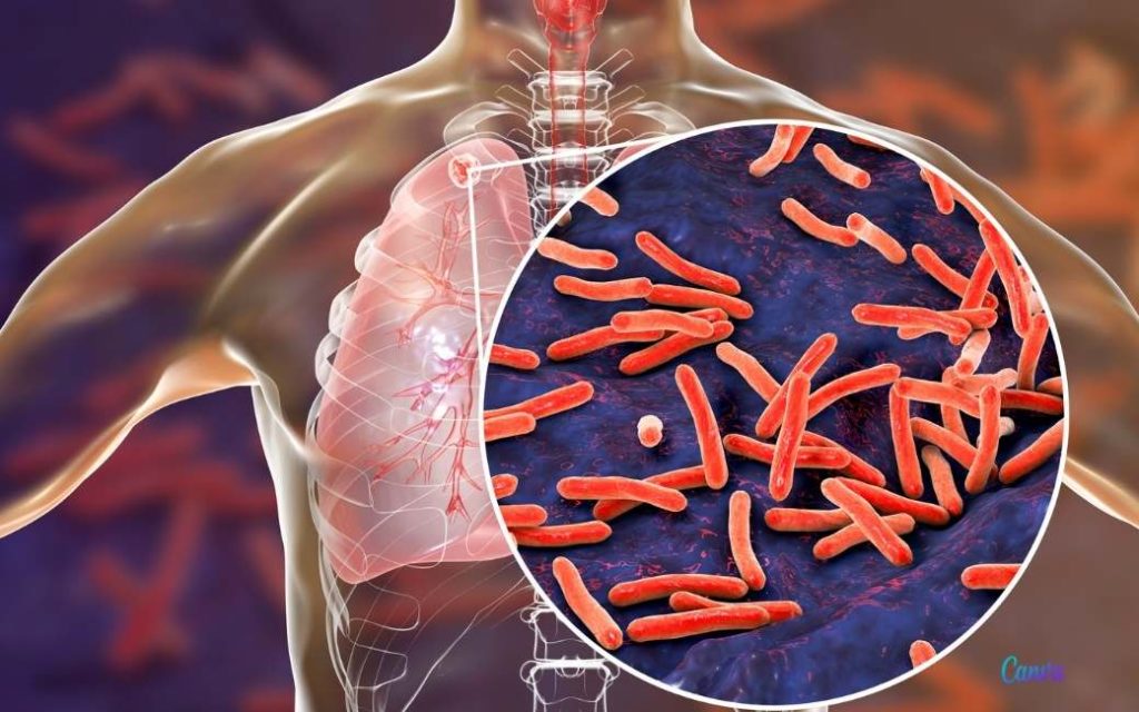 In Álora en Torremolinos stijgt het aantal gevallen van tuberculose het meest in Andalusië